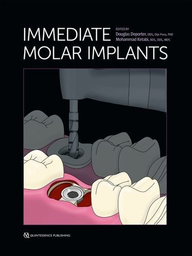 Immediate Molar Implants