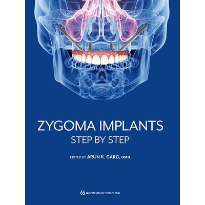 Zygoma Implants