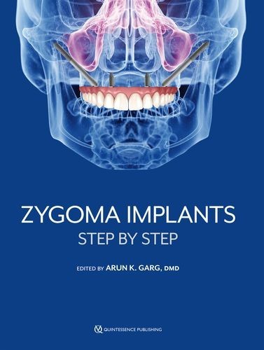 Zygoma Implants