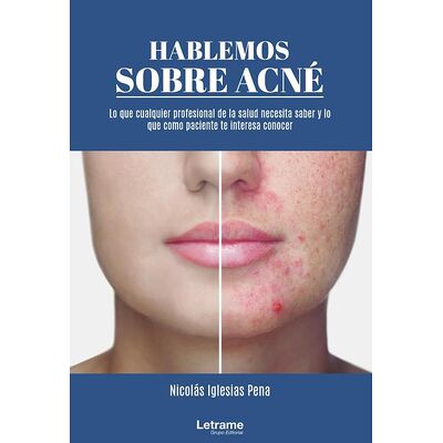 Hablemos sobre acné