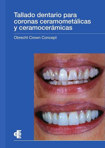 Tallado dentario para...