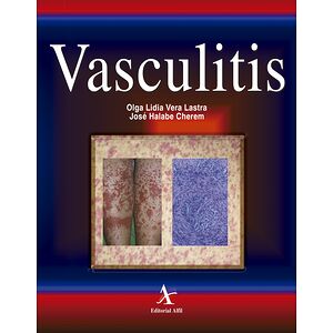 Vasculitis