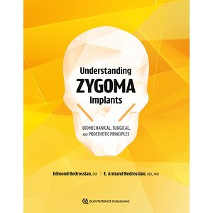 Understanding Zygoma Implants