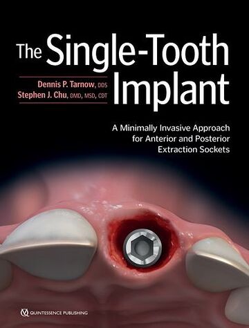 The Single-Tooth Implant: