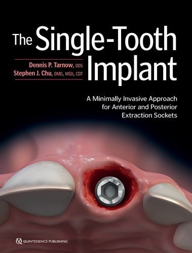 The Single-Tooth Implant: