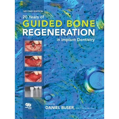 20 Years of Guided Bone...