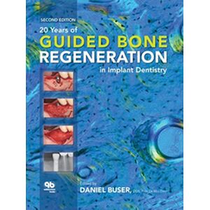 20 Years of Guided Bone...