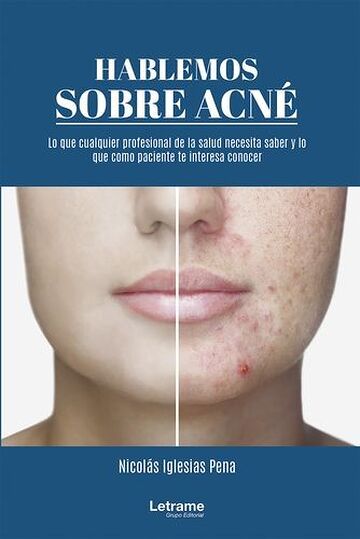 Hablemos sobre acné: 01...